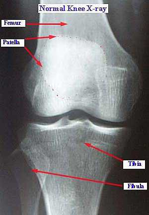 Knee joint Antero-Posterior View