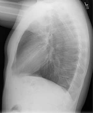 Chest X-Ray Lateral View