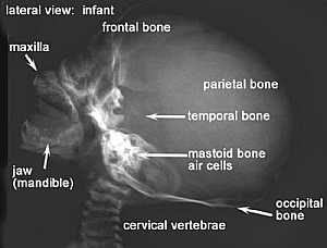 Infant Skull X-Ray Lateral View