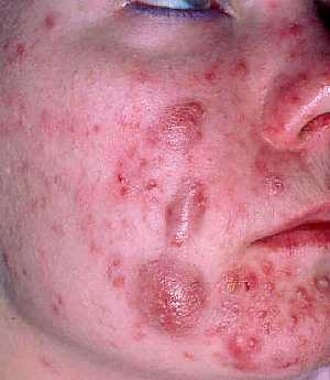 Acne Vulgaris with Cystic lesion