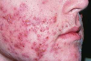 Acne Vulgaris with Cystic lesion