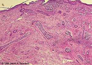 Basal Cell Carcinoma (Histology-Morpheaform Type)