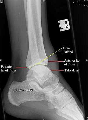 Ankle Joint Lateral View