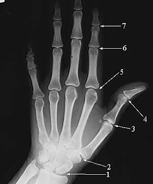Upper Limb X-Ray
