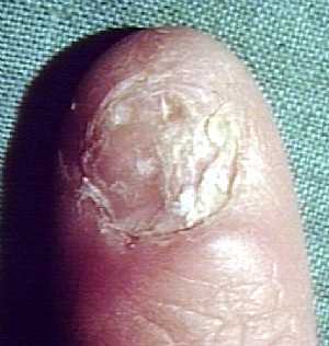 Lichen Planus of the Nail