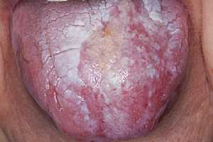Lichen Planus of the Tongue