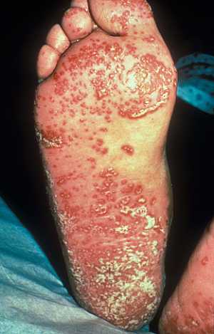 Psoriasis of the soles