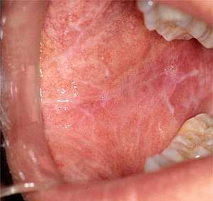 Reticular Oral Lichen Planus