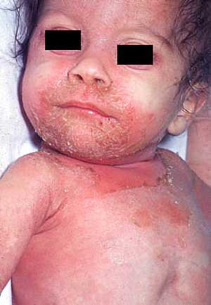 Staphylococcal Scaled Skin Syndrome