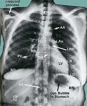 Chest X-Ray Anteo-Posterior View