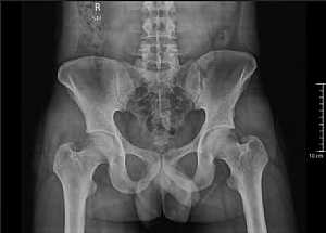 Male Pelvic X-Ray