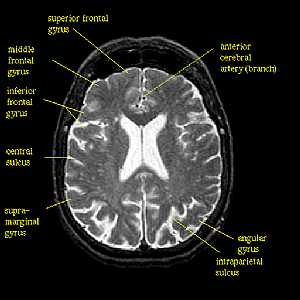 Brain MRI - Frontal