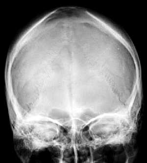 Normal Skull X-Ray Anteroposterior View