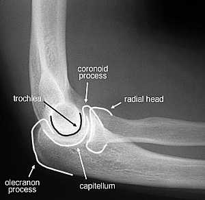 Elbow Joint X-Ray Lateral View