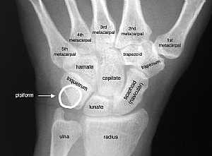 Wrist Joint X-Ray