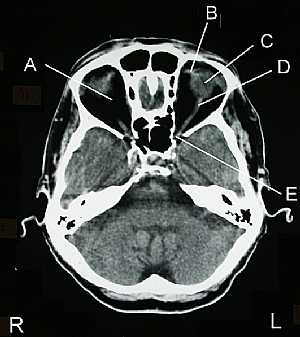 Skull CT Scan
