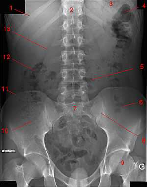 Abdominal X-Ray