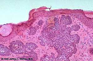 Basal Cell Carcinoma (Histology-Nodular Type- High power)