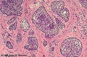 Basal Cell Carcinoma (Histology-Nodular Type - High power)