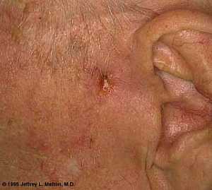 Basal Cell Carcinoma ("Rodent Ulcer" Type)