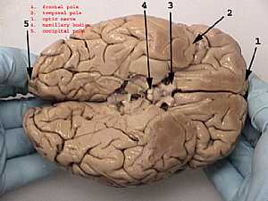Cerebral hemispheres
