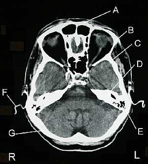 Skull CT Scan