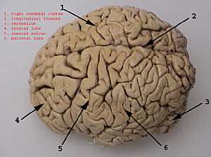 Cerebral hemispheres