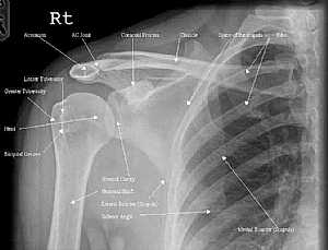 Shoulder Joint X-Ray