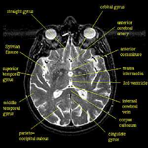 Brain MRI - Temporal