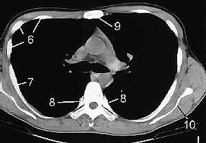 Chest CT Scan - Thoracic cage
