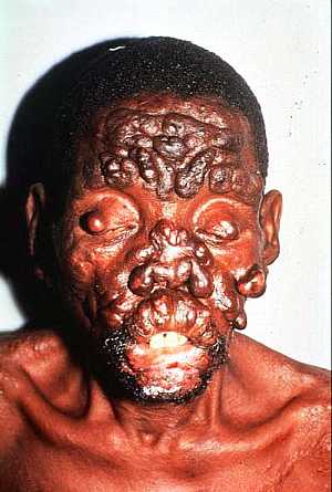 Lepromatous leprosy