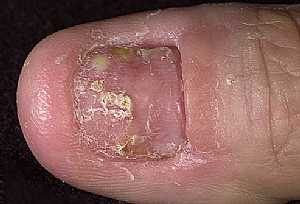 Psoriasis of The Nail