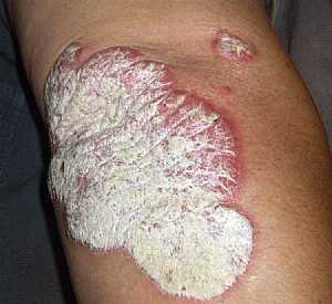 Psoriasis of the Elbow