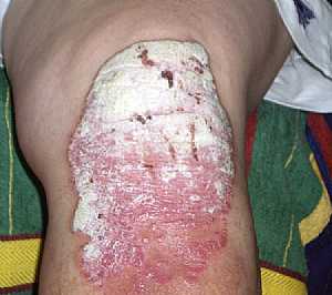 Psoriasis of the knee