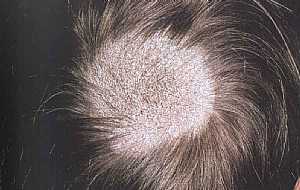 Tinea Capitis (gray Patch)