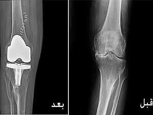 دراسة: ثلث جراحات استبدال مفصل الركبة فى أمريكا غير ملائمة