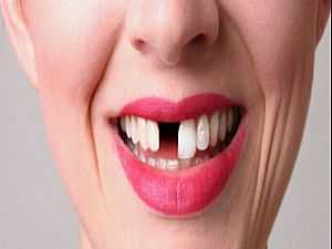 فقدان الأسنان بين المسنات قد يكون مؤشرا عن المعاناة من ضغط دم